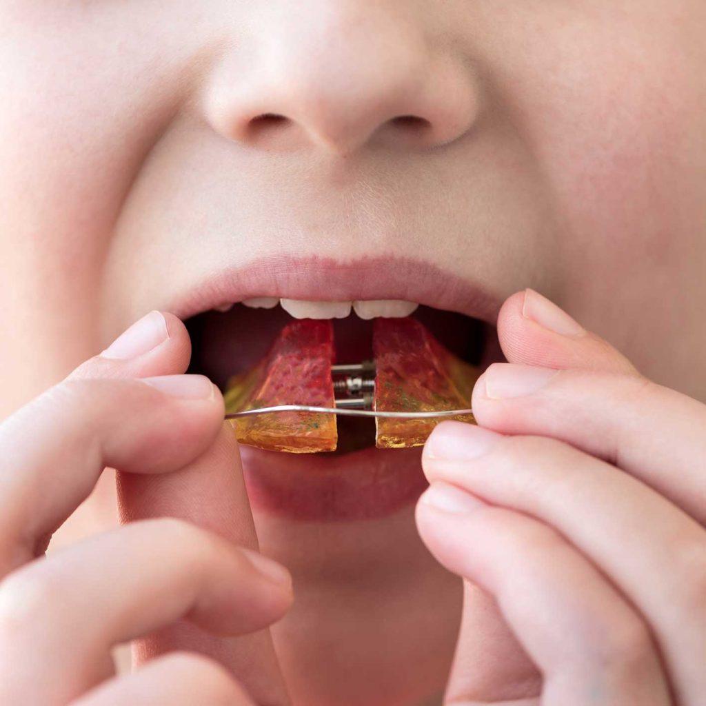 La ortodoncia infantil